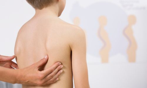Scoliosis